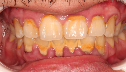 Periodontitis, la enfermedad crónica no contagiosa que puedes tener sin saber