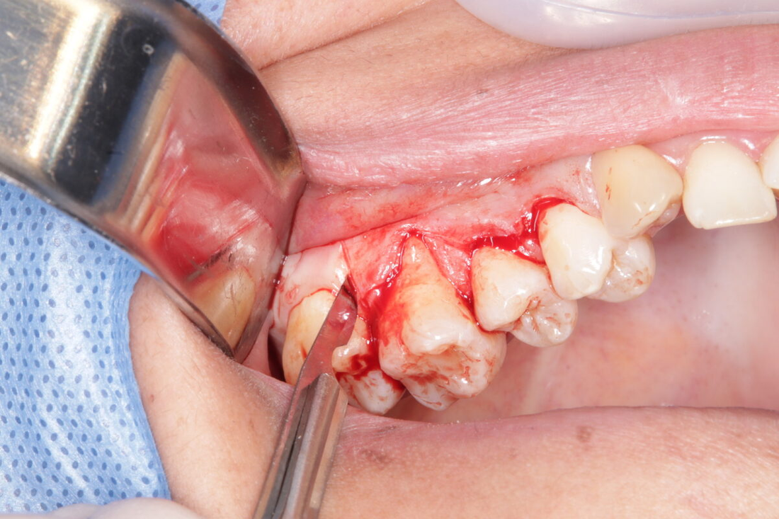 ¿Qué son las Recesiones gingivales? - Tratamiento y prevención