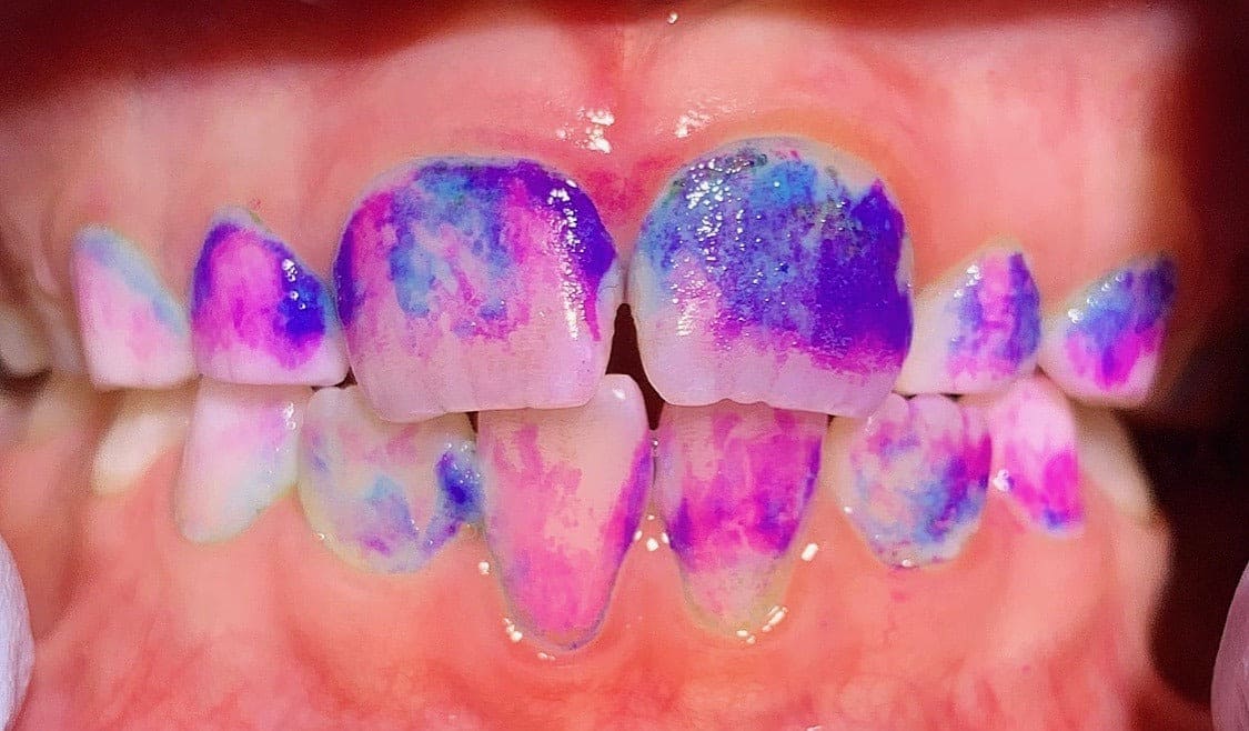 Pastillas Reveladoras de placa Curaprox 12 unidades