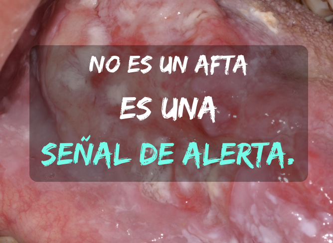 Cinco hallazgos sorprendentes sobre tu boca y el riesgo de cáncer